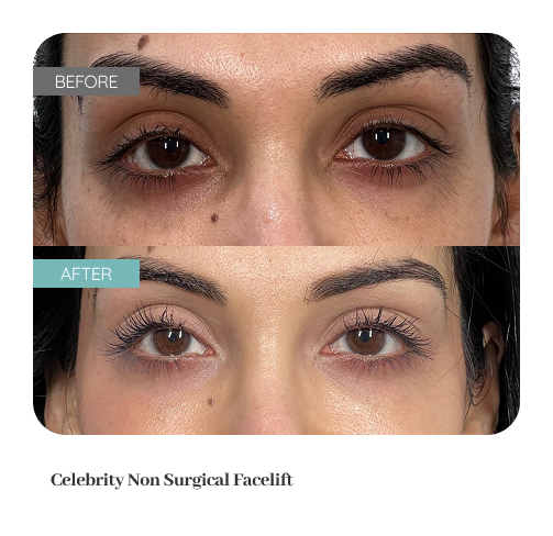 Before and after result